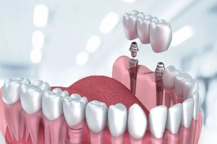 Bir gündə 11 diş implantı  etdirən 75 yaşlı qadın öldü 