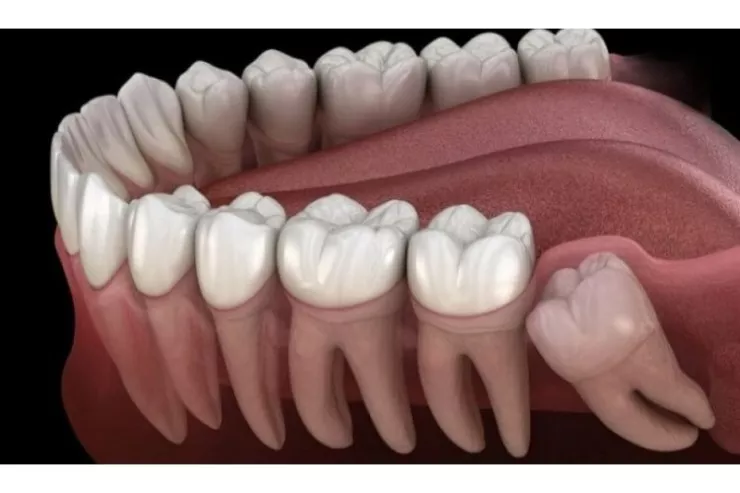 Bütün insanların ağıl dişləri  olmur - Onlar nəyə lazımdır? 