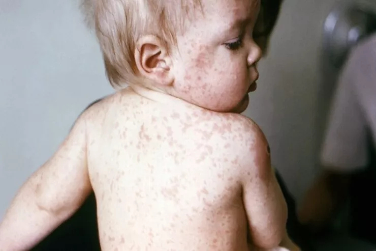 Bakıda uşaq evində FACİƏ:  2 yaşlı uşaq qızılcadan ÖLDÜ 