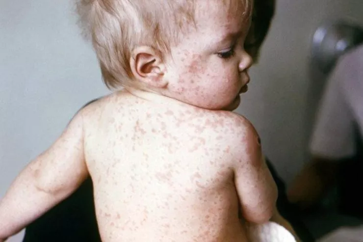 Uşaqlar arasında qızılcaya yoluxma artıb - Pediatrdan və nazirlikdən AÇIQLAMA  - YENİLƏNİB 