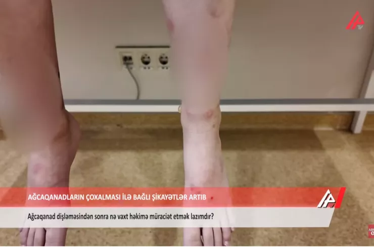 Builki ağcaqanadlar Bakı sakinlərini xəstəxanalıq etdi -VİDEO 
