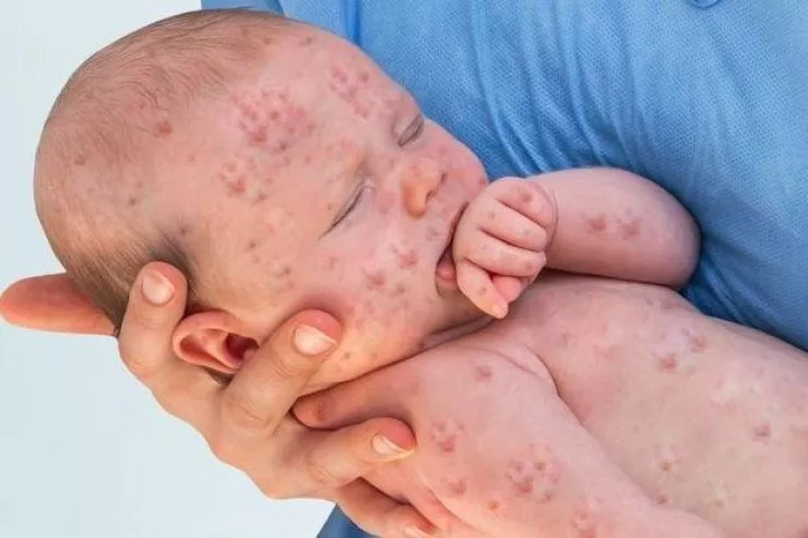 Qızılca epidemiyasından ölən uşaqların sayı  700-ü keçdi